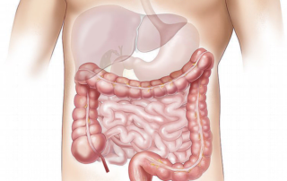 Cancerul de colon-Oncoforte