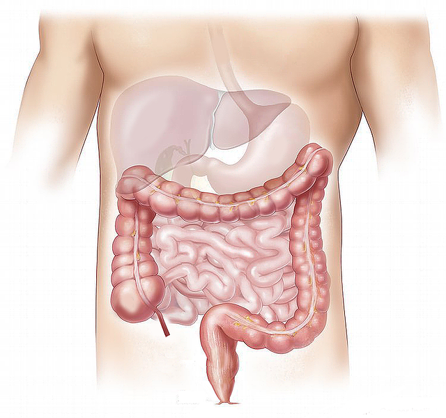 Cancerul de colon-Oncoforte