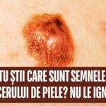Semnele cancerului de piele