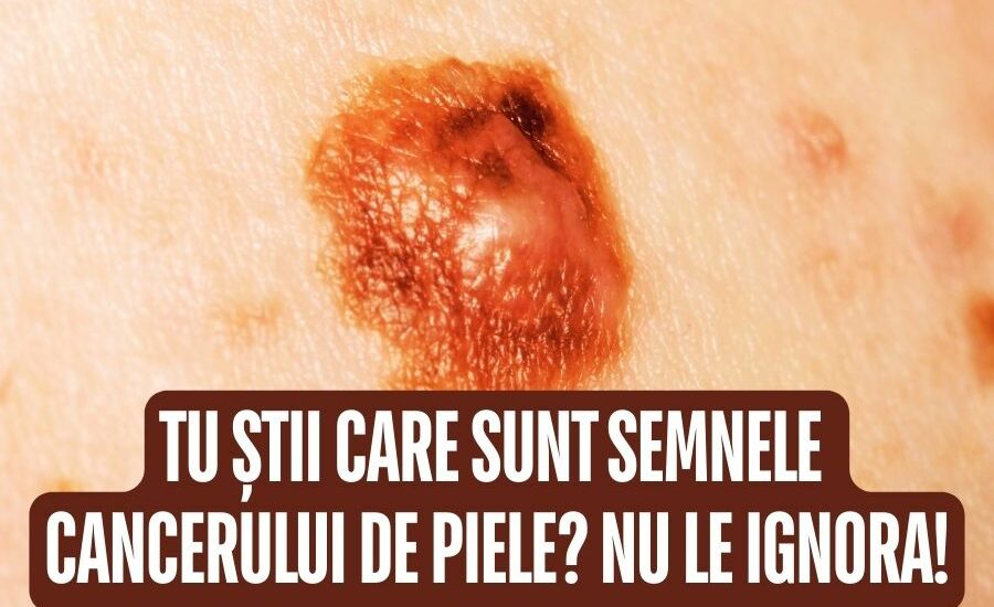 Semnele cancerului de piele